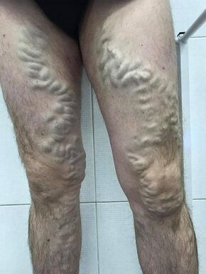 beparvo qilingan erkak varikoz tomirlari