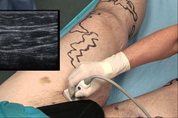 erkaklarda varikoz tomirlari diagnostikasi